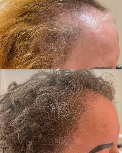 Antes e Depois - Densidade Capilar