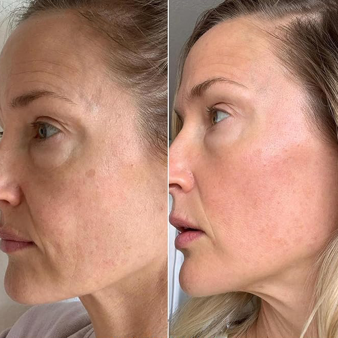 Antes e Depois - Rejuvenescimento Facial