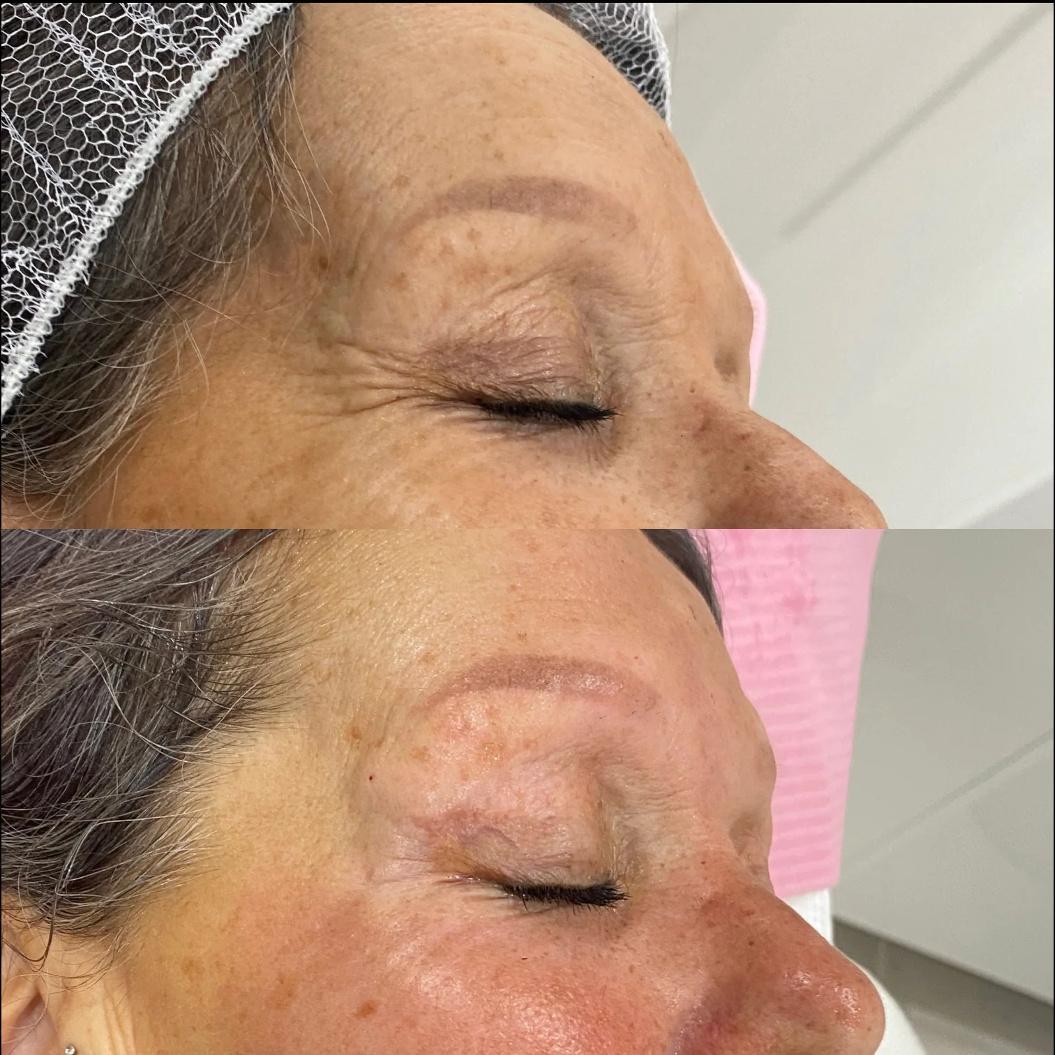 Antes e Depois - Melasma