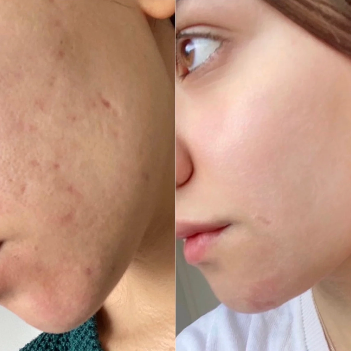 Antes e Depois - Reconstrução de Cicatriz de Acne